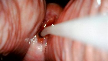 AnalSlut Inseminated - Pussy gaping from Speculum - cum inserted direct into her uterus