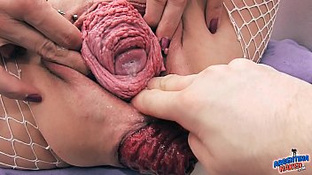 Most Incredible Prolapse Scene! Cervix, Fisting, Max Stretch